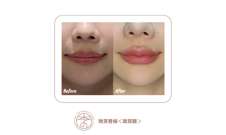 台中醫美推薦,台中醫美,台中減重,台中減重診所推薦,台中醫美診所推薦,台中醫美診所-李子美學診所